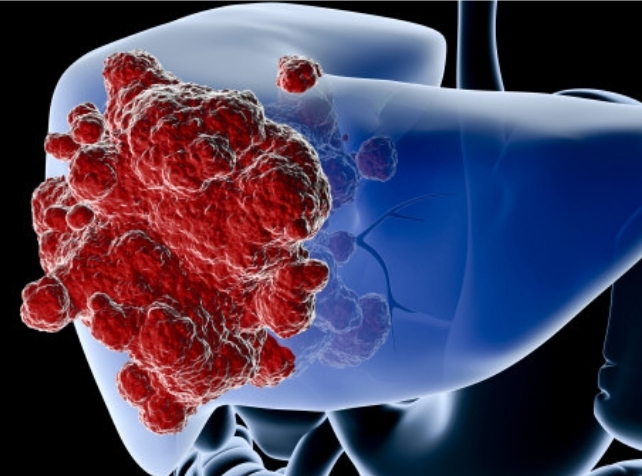 Liver cancer deaths and diagnosis rates have climbed over